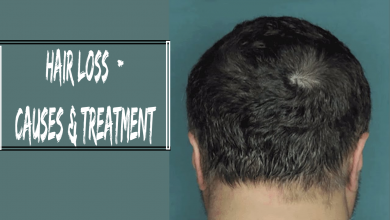 Photo of Hair Loss: – Causes & Treatment for Hair Loss