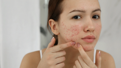 Photo of Home Remedies for Acne – Ayurveda Treatment
