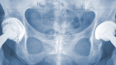 Photo of Joint Replacement Surgery Benefits