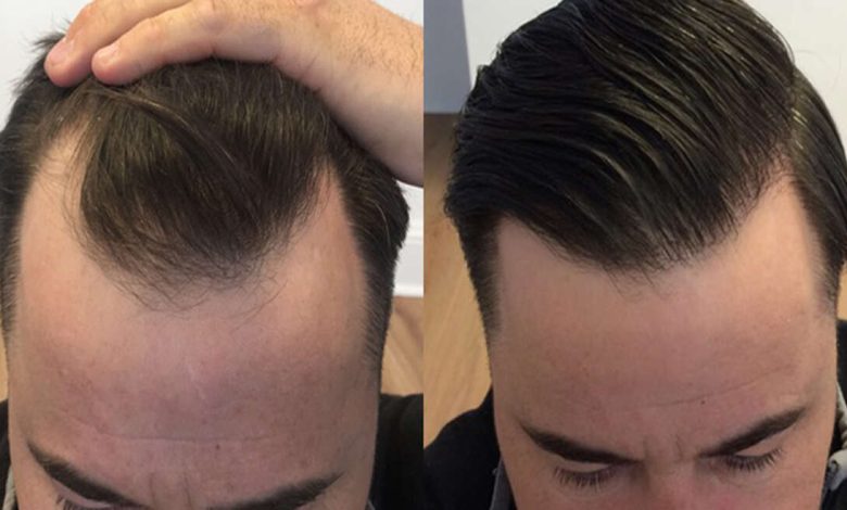 Hair Transplant