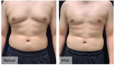 Photo of Motivational Story Of A Successful Gynecomastia Surgery Candidate